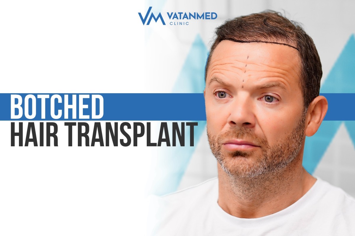 1-Hair Transplant